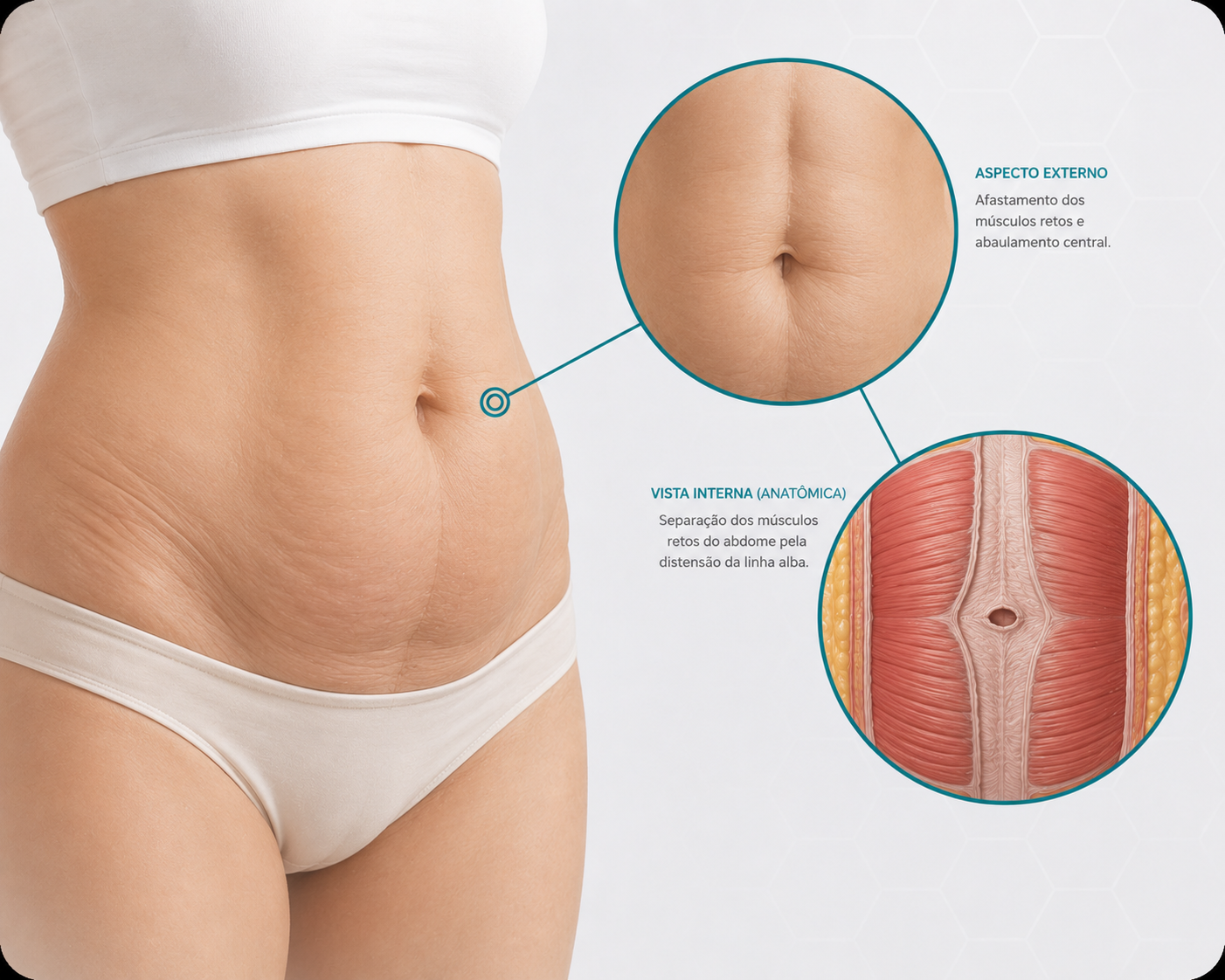 Diástase abdominal